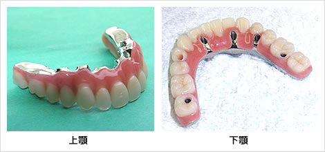 ボ－ンアンカ－ド義歯 